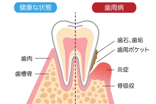 歯周病治療